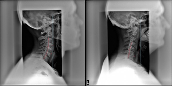 Rachide Cervicale importanza di una corretta curva 008 spine center