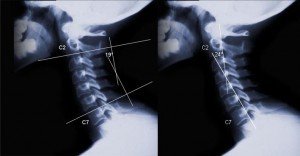 Valutazione della curva Cervicale 004 spine center