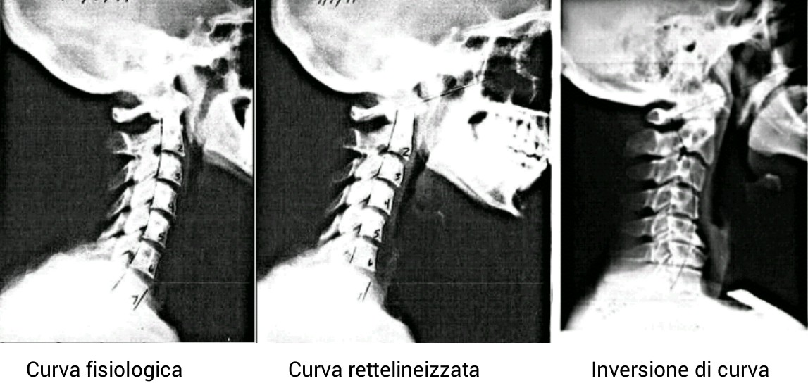 TEXT NECK LA SINDROME TECNOLOGICA 003 spine center