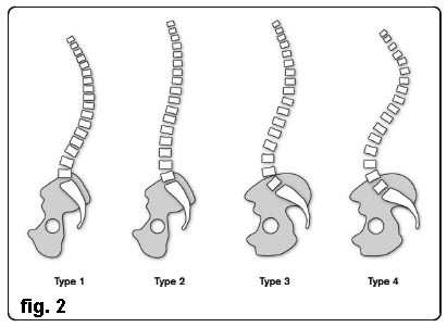 Lombalgia Sci 003 spine center