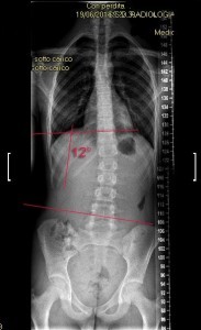 SCOLIOSI valutazione della colonna senza raggi X Formetric 002 spine center