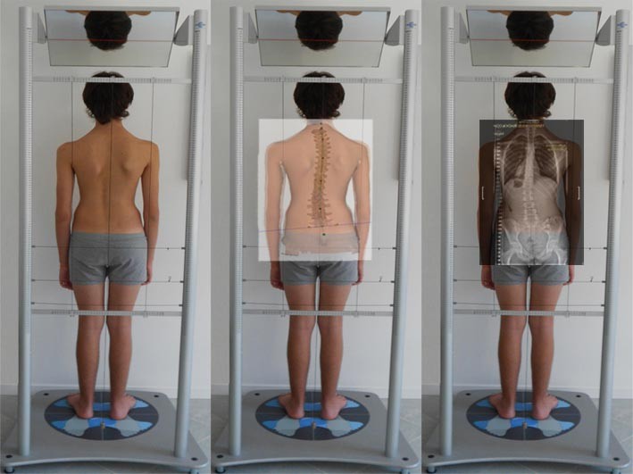 SCOLIOSI valutazione della colonna senza raggi X Formetric 003 spine center