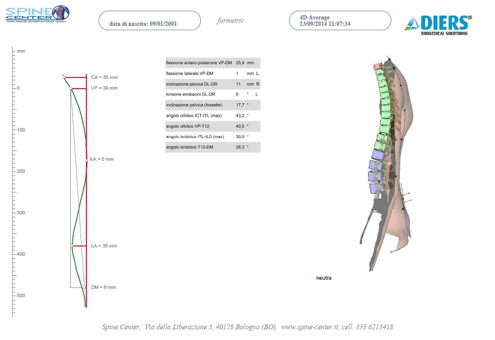 SCOLIOSI valutazione della colonna senza raggi X Formetric 005 spine center