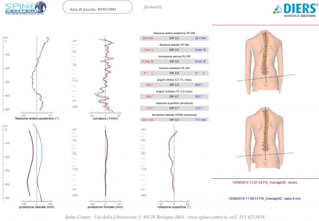 SCOLIOSI valutazione della colonna senza raggi X Formetric 007 spine center