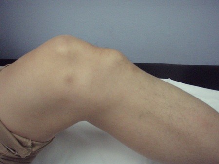 La sindrome di Osgood Schlatter 002 spine center