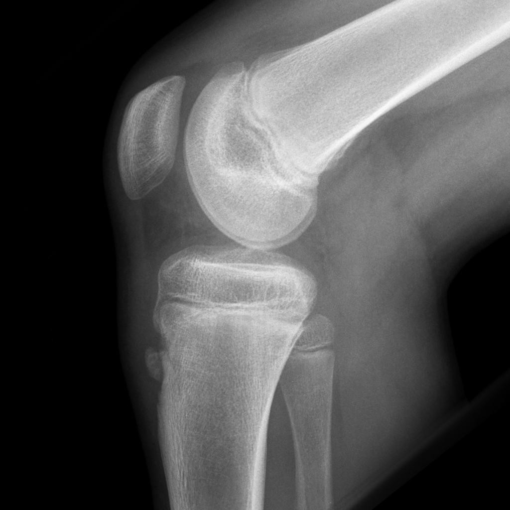 La sindrome di Osgood Schlatter 003 spine center