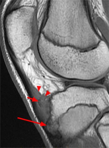La sindrome di Osgood Schlatter 004 spine center