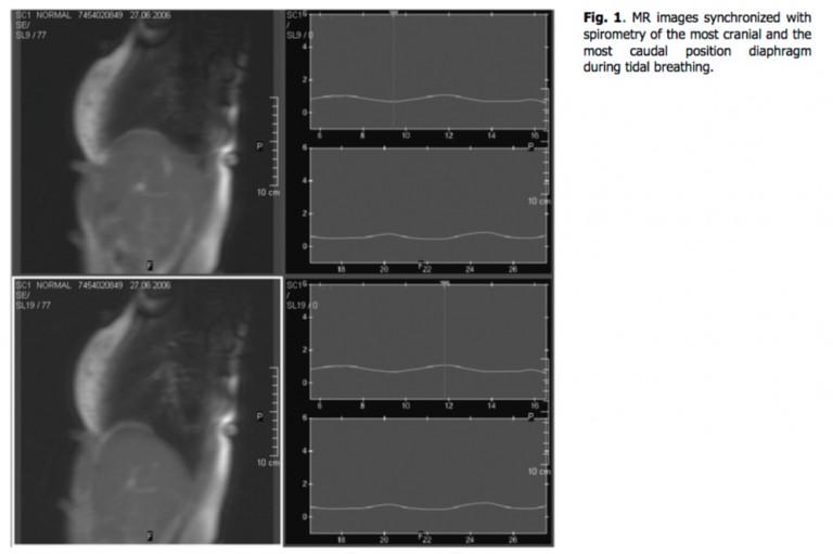 Diaframma in differenti posture valutato con la RMN 002 spine center