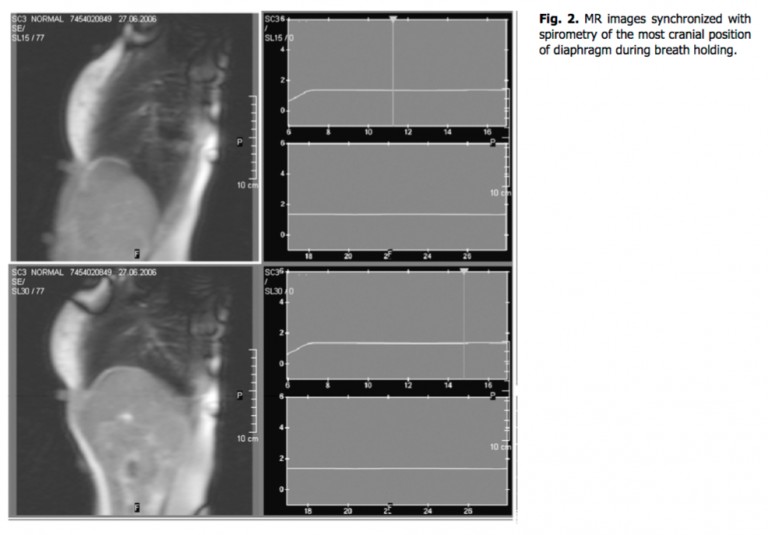 Diaframma in differenti posture valutato con la RMN 003 spine center