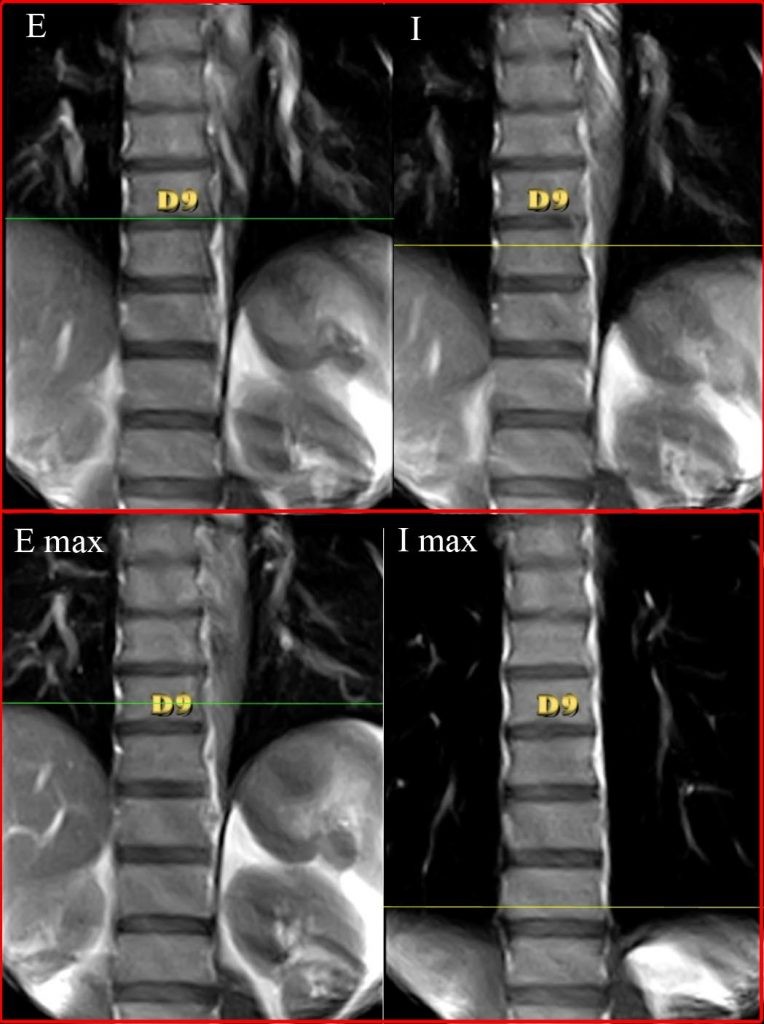 Diaframma in differenti posture valutato con la RMN 009 spine center
