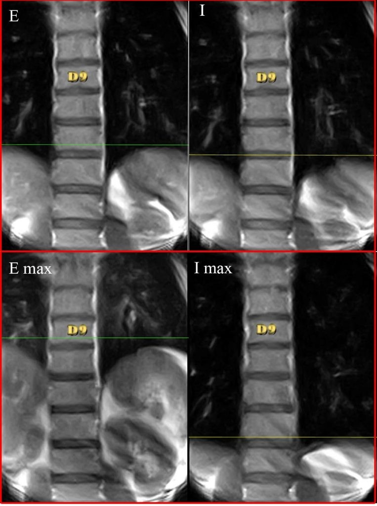 Diaframma in differenti posture valutato con la RMN 010 spine center
