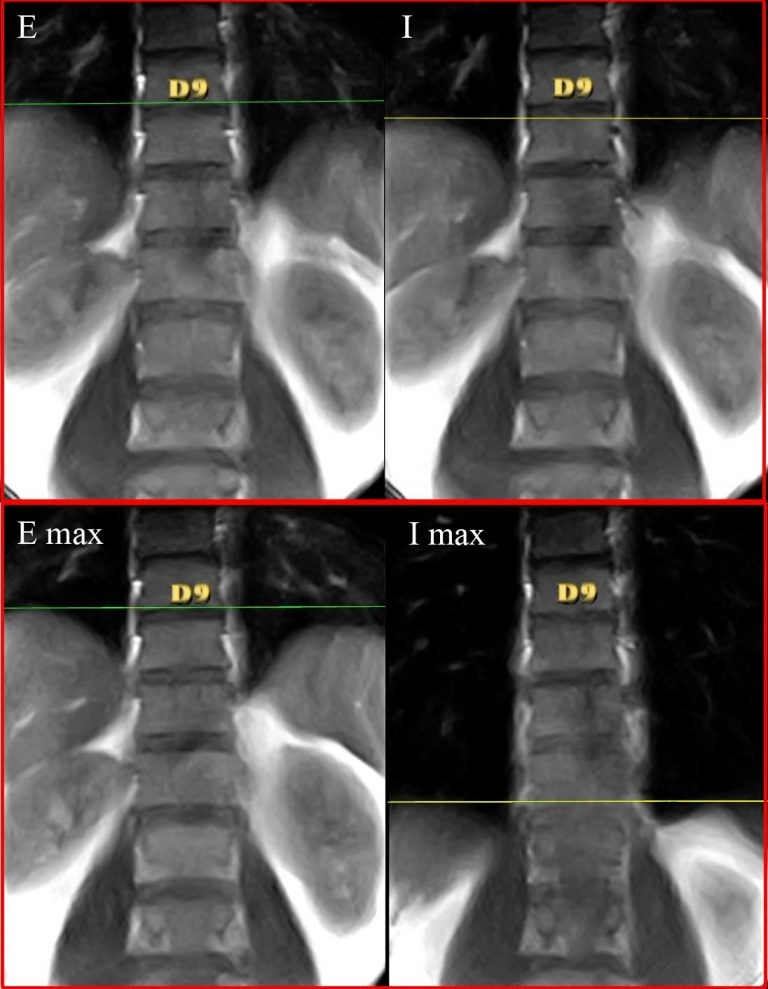 Diaframma in differenti posture valutato con la RMN 011 spine center