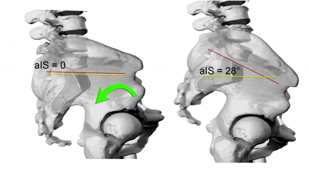 CONSIDERAZIONI SULLANGOLO DI INCIDENZA PELVICA 008 spine center
