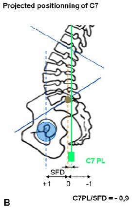 Il Rachide sul Piano Sagittale 003 spine center