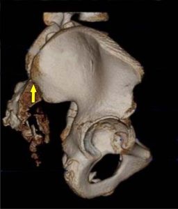 Revisione critica del test di flessione in piedi e seduto 007 spine center