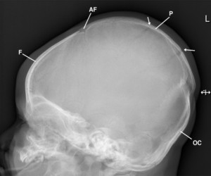 Osteopatia neonatale 009 spine center