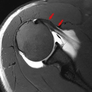 Instabilità di spalla quali muscoli rinforzare 005 spine center