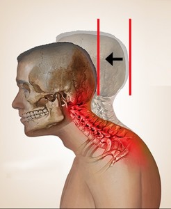 Terapia Manuale ed Esercizio Terapeutico nel trattamento del Neck Pain 003 spine center