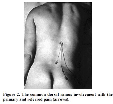 La Sindrome Del Ramo Dorsale nel mal di schiena Cosa sappiamo 002 spine center