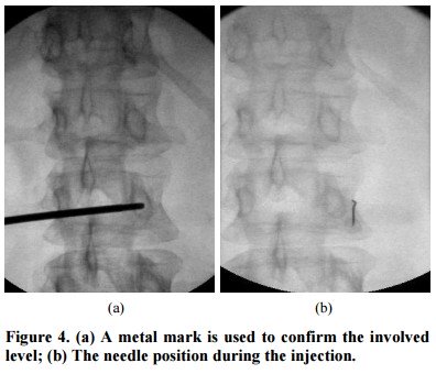 La Sindrome Del Ramo Dorsale nel mal di schiena Cosa sappiamo 004 spine center