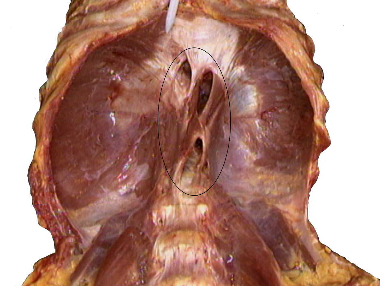 Malattia da reflusso gastro esofageo e terapia manuale 01 spine center