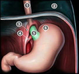 Malattia da reflusso gastro esofageo e terapia manuale 03 spine center