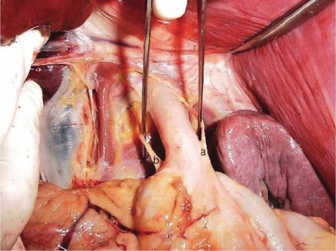 Malattia da reflusso gastro esofageo e terapia manuale 04 spine center