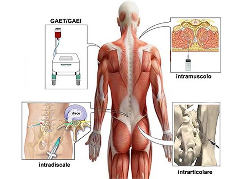 Ossigeno/Ozono terapia nella patologia della colonna vertebrale