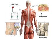 Ossigeno/Ozono terapia nella patologia della colonna vertebrale