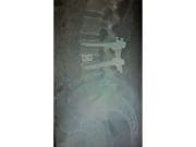 LA MODERNA CHIRURGIA VERTEBRALE